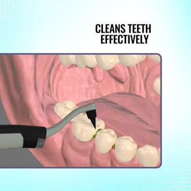Ultrasonic Teeth Stain Remover (ETSE)