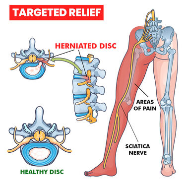 Sciatica Belt for Pain Relief (PRS49)